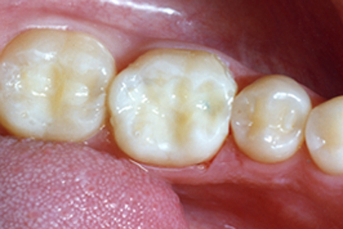 Everything You Need To Know About Composite Fillings