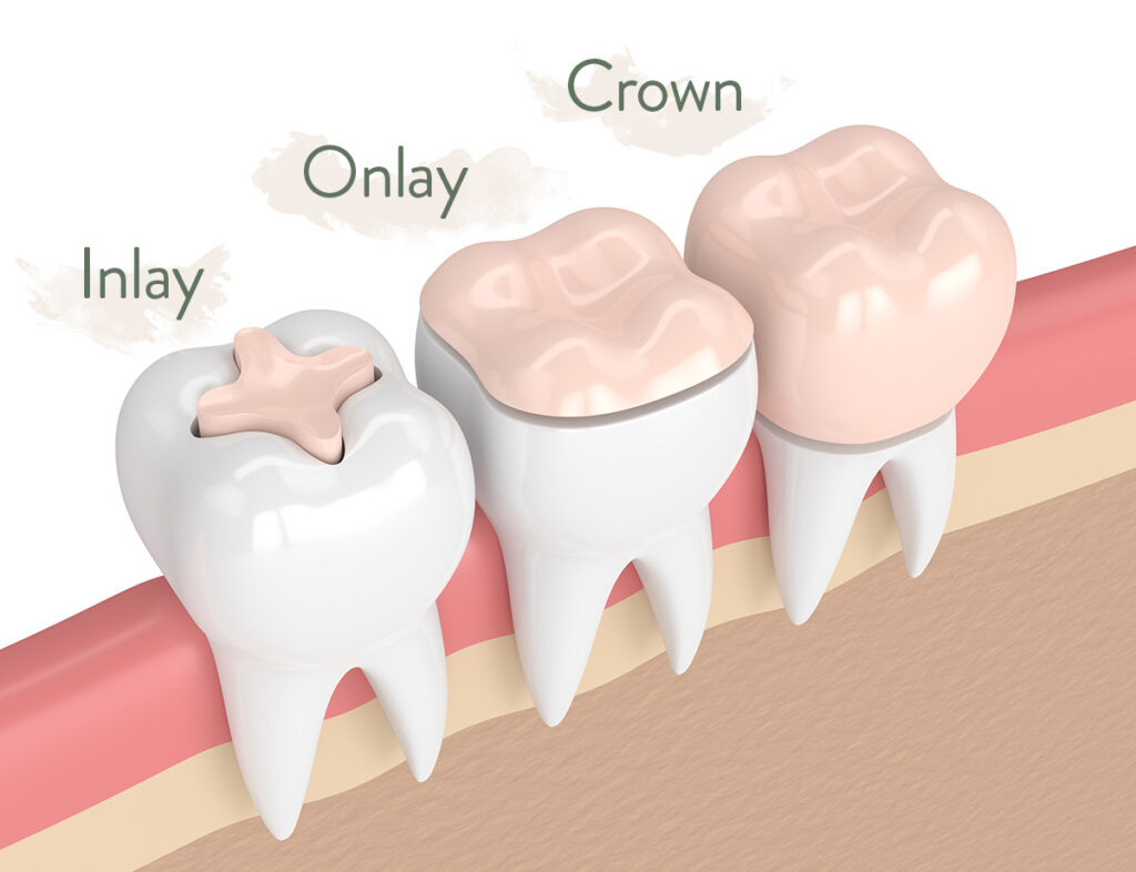 A visual comparison of inlays, onlays, and crowns, shown on teeth.