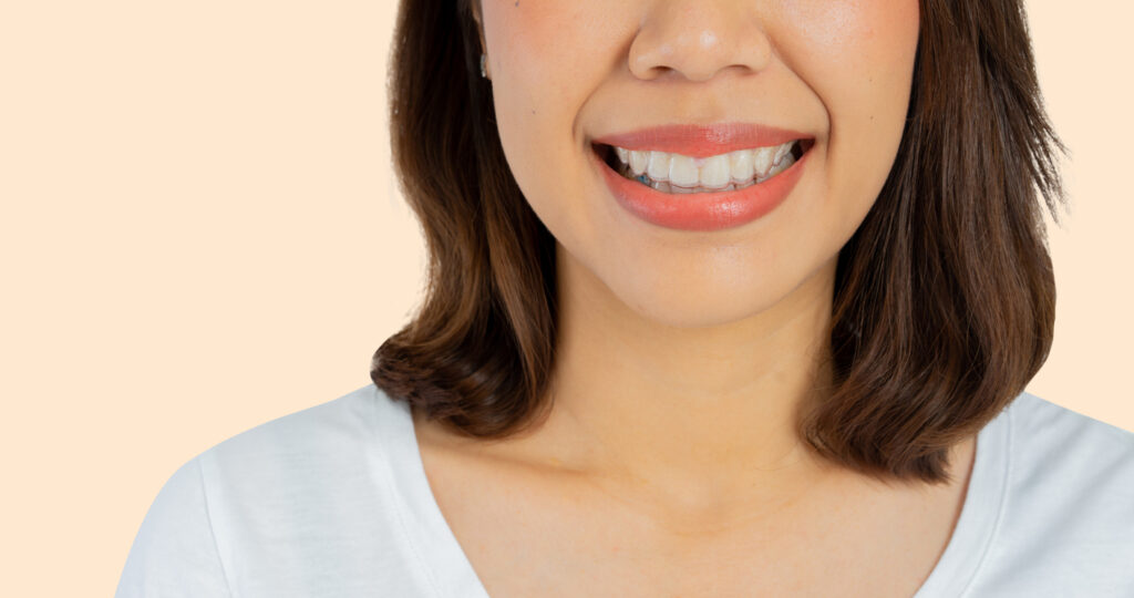 close up young beautiful asian woman smiling with dental aligner retainer tool (invisalign) isolated on cream color background of dental clinic for beautiful teeth treatment course concept.