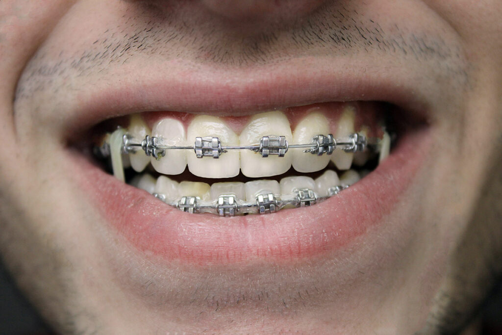 A close-up of an adult man with braces.