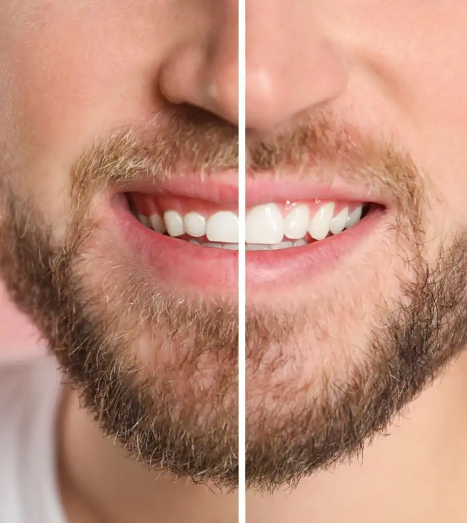 Before and after of gum contouring